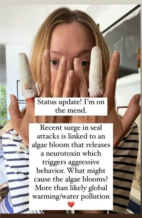 Sao bị hải cẩu cắn ảnh 1 Sao bi hai cau can anh 1