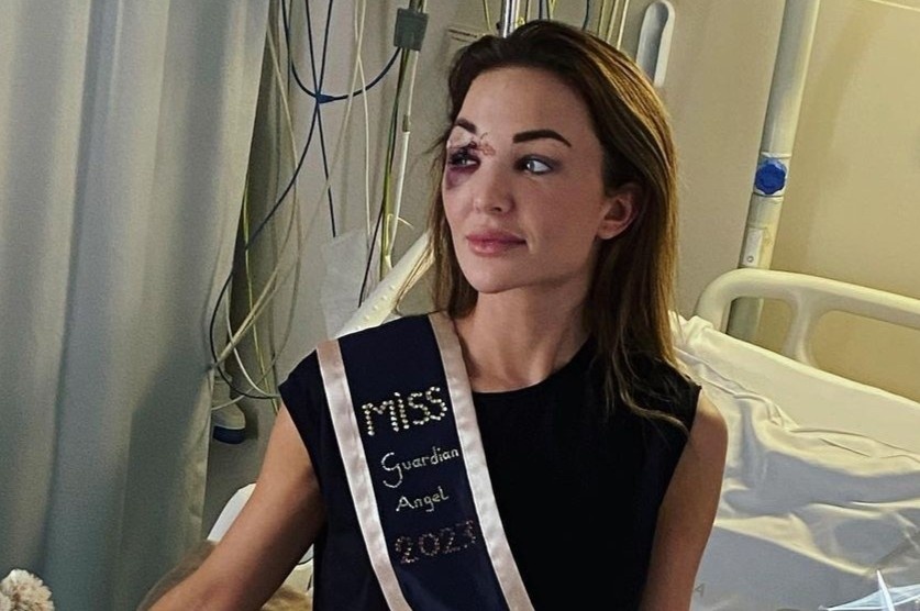 Hoa hau Bi bi bien dang khuon mat sau tai nan hinh anh