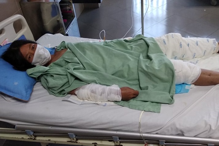 Vo bong nang toan than vi chong do xang dot hinh anh