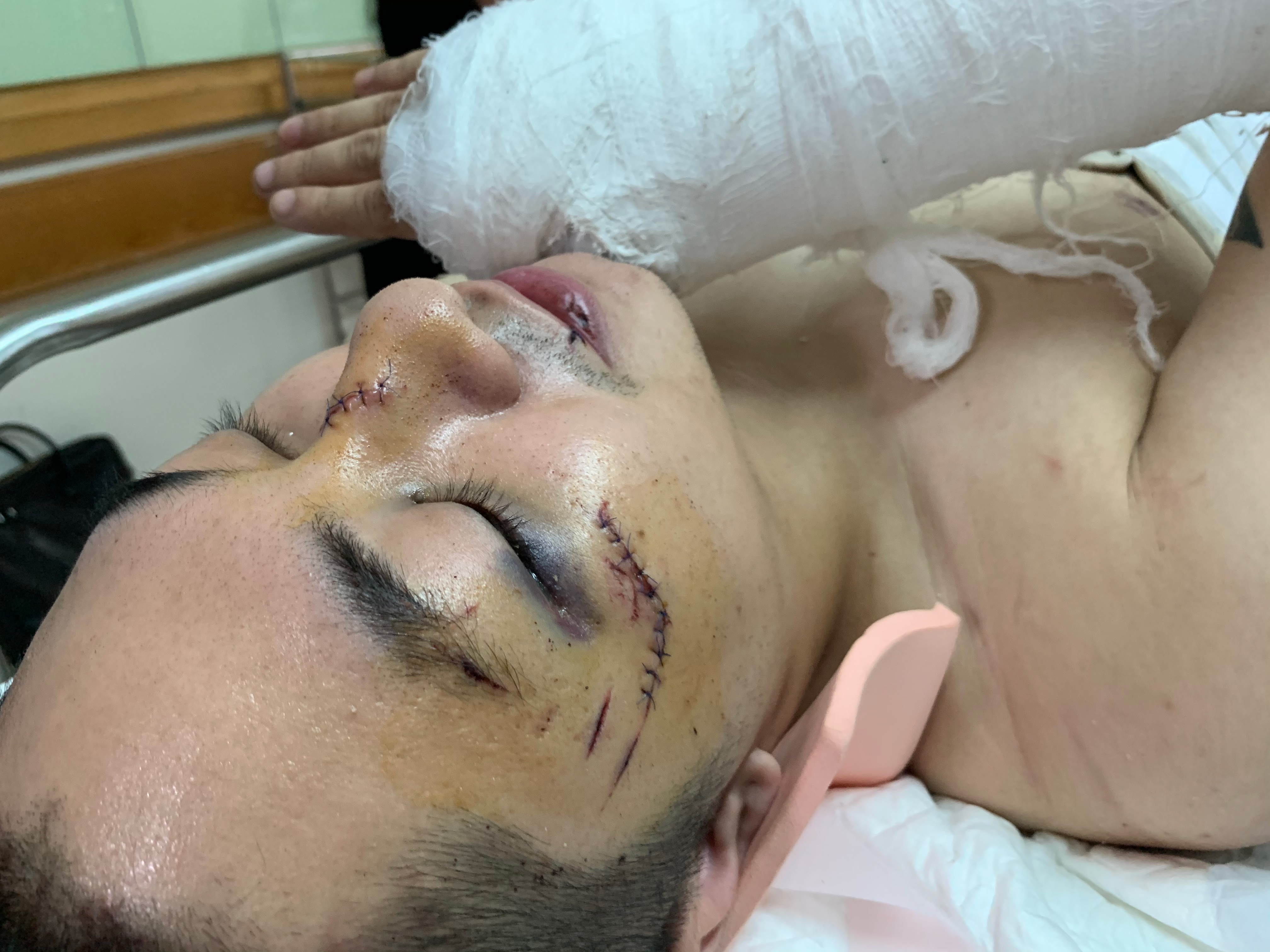 Vu thung san chung cu: Nan nhan bi gay xuong song hinh anh