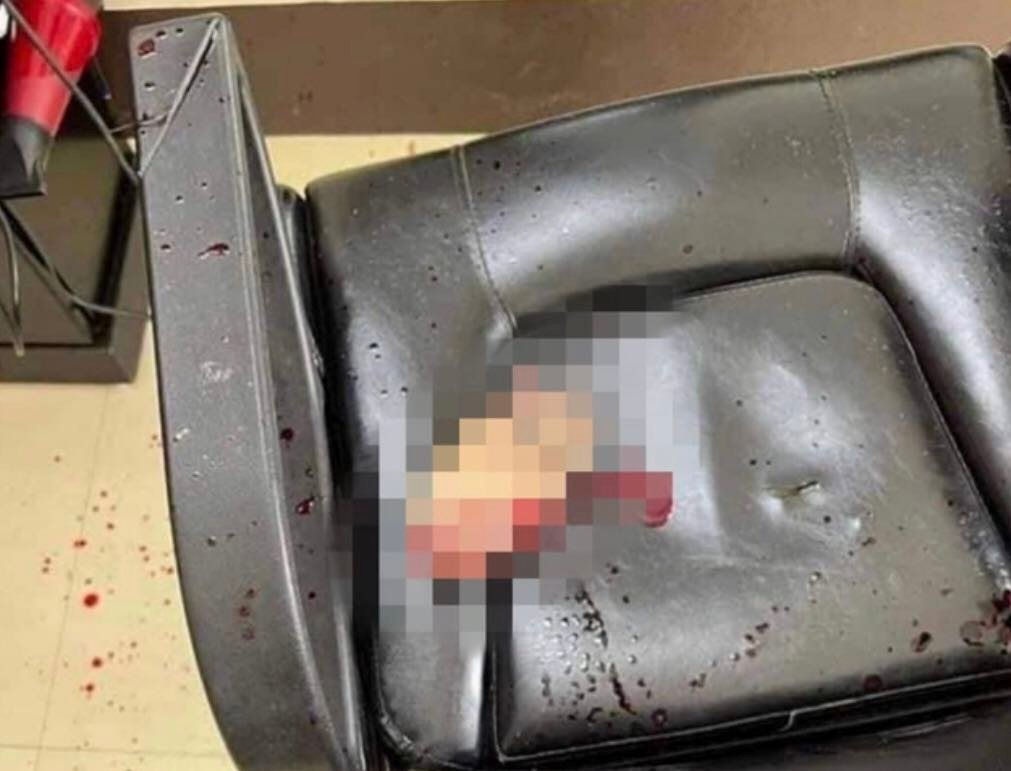 Bi chem dut lia tay, nan nhan phai chuyen ra Ha Noi hinh anh