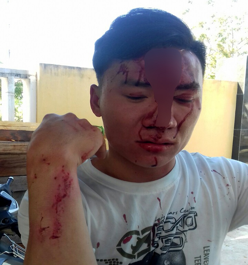 Kiem lam bi hai phu nu danh gay xuong mui hinh anh