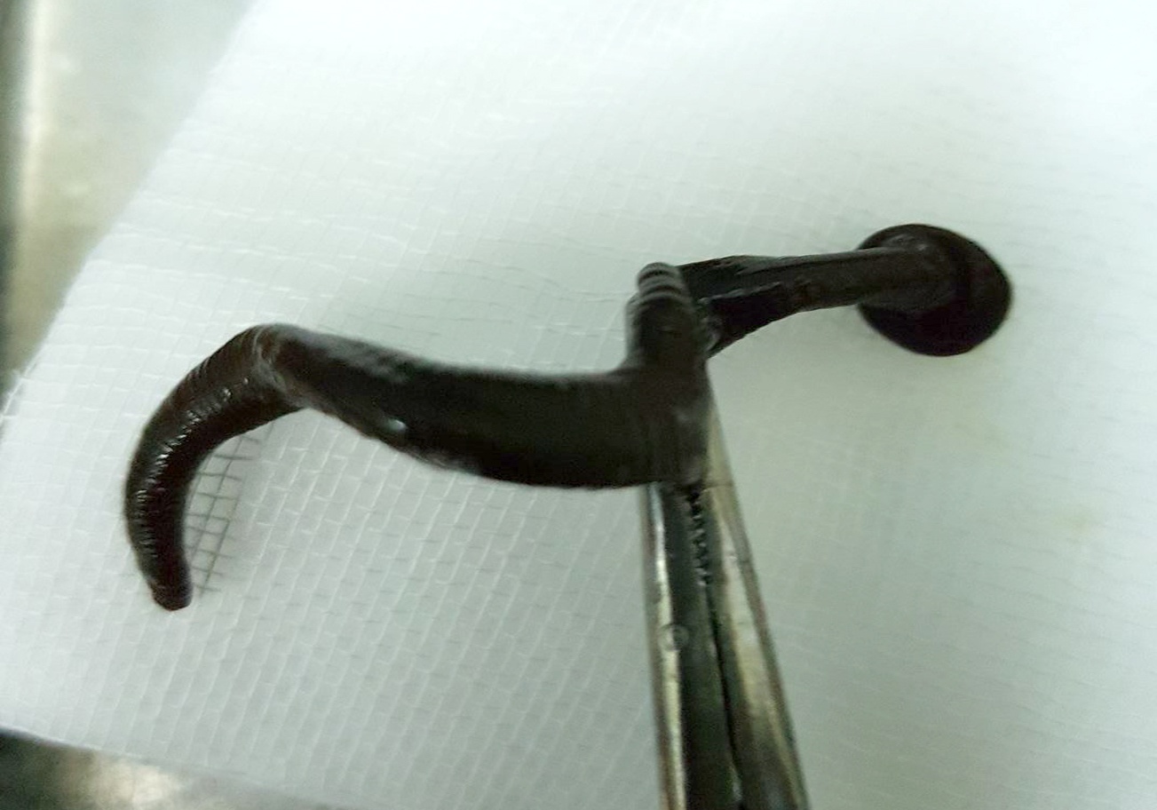 Con dia dai 15 cm no mau nam trong mui benh nhi 9 tuoi hinh anh