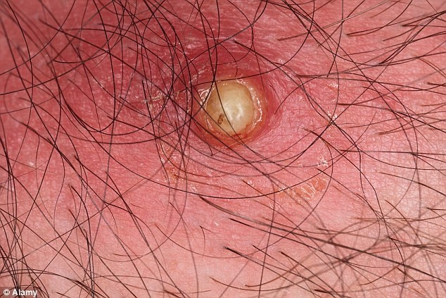 Đây là ấu trùng của ruồi Tumbu, một loại ruồi mà ấu trùng ăn các mô trong cơ thể người. Ảnh: Dailymail.com