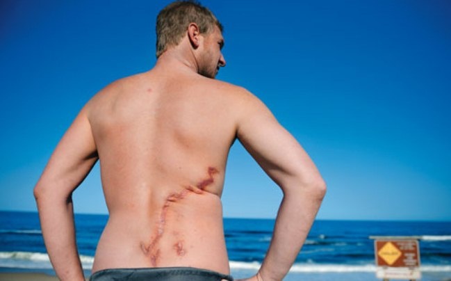 Vào một ngày tháng 8 oi bức, Todd Endris, 24 tuổi, quyết định đi lướt sóng cùng bạn bè. Trong lúc anh đang ở trên mặt nước, một con cá mập dài khoảng 4,5 m xuất hiện. Con cá mập cố đớp anh nhưng miệng không thể khép lại quanh cả tay lướt sóng và tấm ván. Todd kẹt giữa hàm con cá mập và tấm ván, do bụng úp xuống nên nội tạng của anh chưa bị tổn hại nhưng Todd đã mất khá nhiều da lưng. Con cá mập nhả ra và tấn công lần thứ ba, cố nuốt chửng chân phải Todd, nhưng điều đó khiến tay lướt sóng có điểm tựa để đá vào mõm con cá mập cho tới lúc nó phải buông ra. Lúc Todd đã kiệt sức và nghĩ mình chết chắc, một đàn cá heo xuất hiện tạo thành vòng tròn bảo vệ quanh anh, cầm chân con cá mập đủ lâu để Todd đón được một cơn sóng bơi vào bờ cho bạn bè cấp cứu.