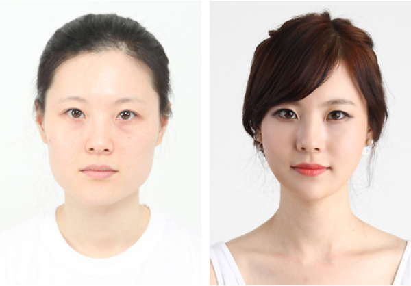 Phẫu thuật thẩm mỹ là chuyện thường và được xã hội đồng tình: Dù hiện nay việc phẫu thuật thẩm mỹ đã phổ biến hơn, mọi người vẫn không thích nói nhiều với đồng nghiệp hay bạn bè nếu có thực hiện. Ở Hàn Quốc thì ngược lại, chuyện “dao kéo” được chấp nhận như một phần cuộc sống. Sau khi phẫu thuật, nhiều người được các đồng nghiệp, gia đình và bạn bè khen ngợi, chúc mừng. Hàn Quốc hiện là một trong những địa điểm phẫu thuật thẩm mỹ uy tín và nổi tiếng nhất thế giới.