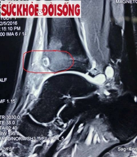 Lan dau tien noi soi khop co chan o Viet Nam anh 1