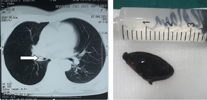 Ho suốt 3 năm mới phát hiện mắc hạt hồng xiêm trong phế quản ảnh 1 Ho suot 3 nam moi phat hien mac hat hong xiem trong phe quan anh 1