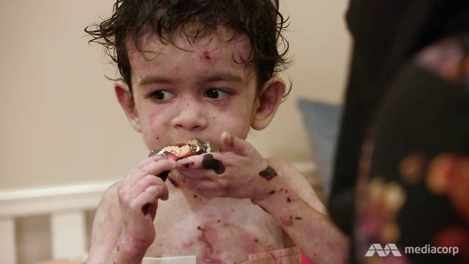 Cuộc sống đầy đau đớn của những đứa trẻ ‘bươm bướm’ ảnh 1 Cuoc song day dau don cua nhung dua tre ‘buom buom’ anh 1