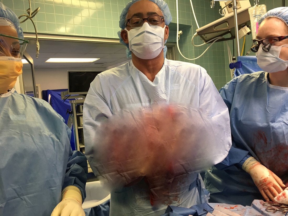 Bụng bia mãi không giảm,  hóa ra là khối u 13 kg ảnh 2 Bung bia mai khong giam,  hoa ra la khoi u 13 kg anh 2