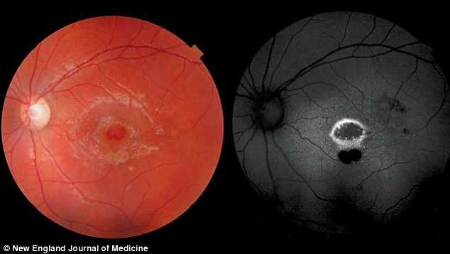 Cậu bé 9 tuổi mù mắt vì đèn laser đồ chơi ảnh 1 Cau be 9 tuoi mu mat vi den laser do choi anh 1