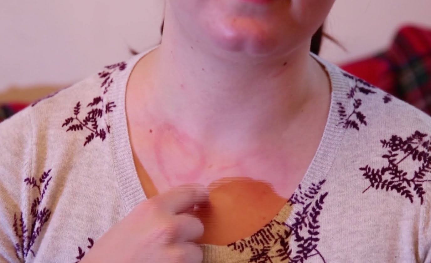 9 chung benh di ung la lung tren the gioi anh 7