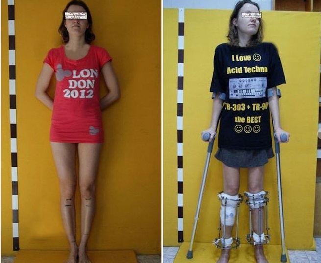 Kéo dài chân: quy trình lạnh gáy như tra tấn thời trung cổ ảnh 2 Keo dai chan: quy trinh lanh gay nhu tra tan thoi trung co anh 2