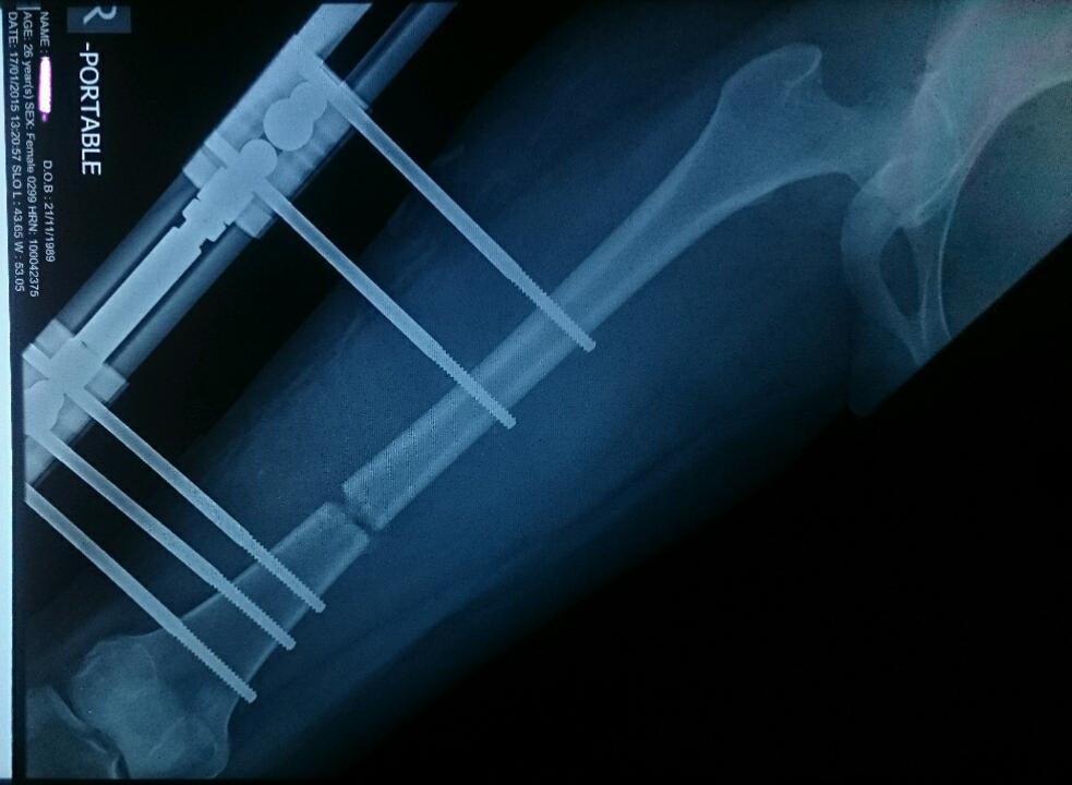 Kéo dài chân: quy trình lạnh gáy như tra tấn thời trung cổ ảnh 1 Keo dai chan: quy trinh lanh gay nhu tra tan thoi trung co anh 1