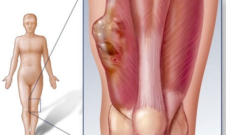 10 loai ung thu pho bien nhat o nguoi tre tuoi anh 7