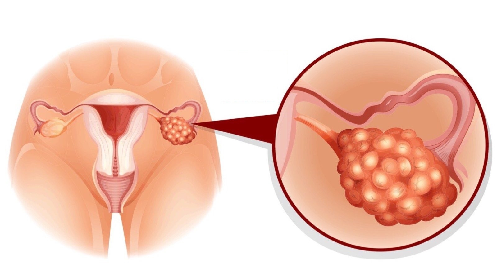 10 loai ung thu pho bien nhat o nguoi tre tuoi anh 9