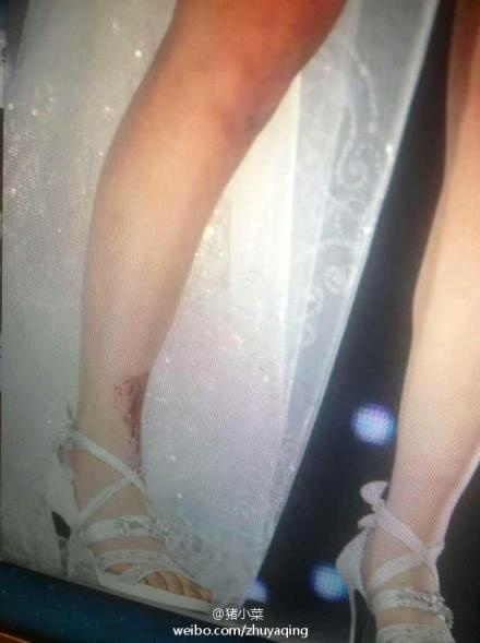 Suzy hoàn thành hết bài biểu diễn dù chân chảy máu và bầm tím. Ảnh: weibo