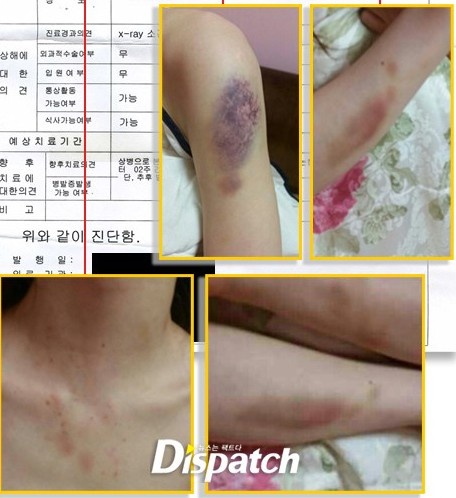 Hình ảnh cơ thể bầm tím của bạn gái Kim Hyun Joong công bố trên báo Dispatch ngày