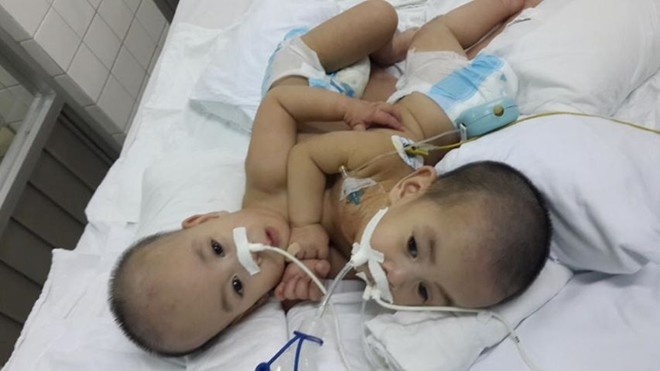 Clip ca phau thuat tach 2 be song sinh dinh lien tim, gan hinh anh