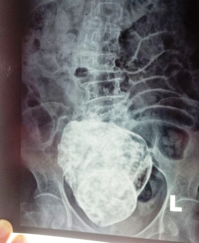 Ảnh chụp X quang bệnh nhân N.T.S