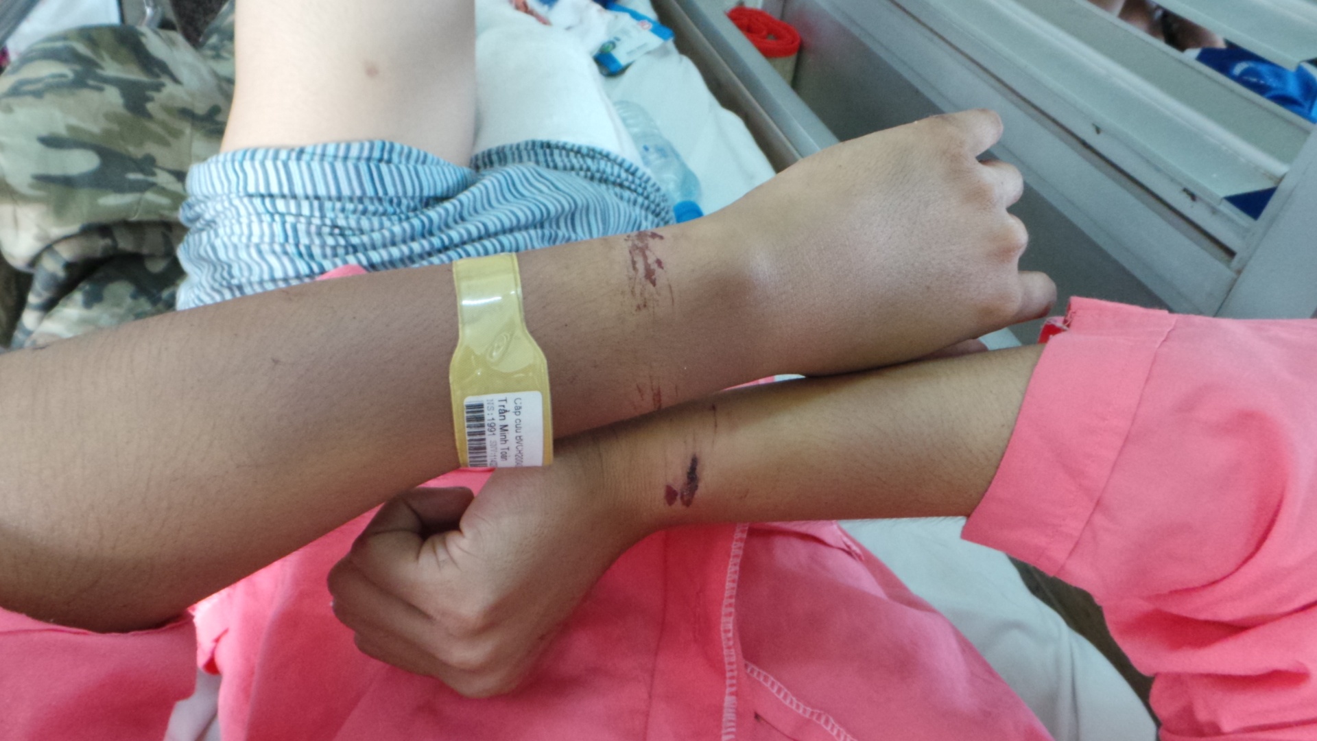 Vết xây sát hai bên cổ tay anh Toàn do bị còng số 8 mà gia đình ông Trung sử dụng gây ra.