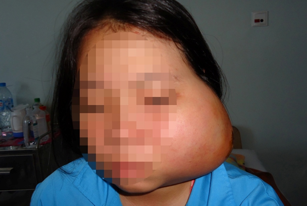 Phau thuat buou gay bien dang mat be gai 15 tuoi hinh anh