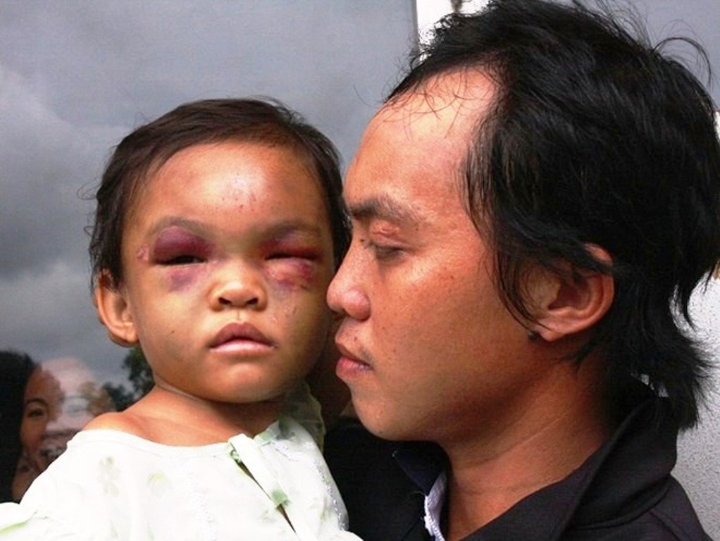 Anh Tố và bé Ngân tại bệnh viện tỉnh Bình Dương.