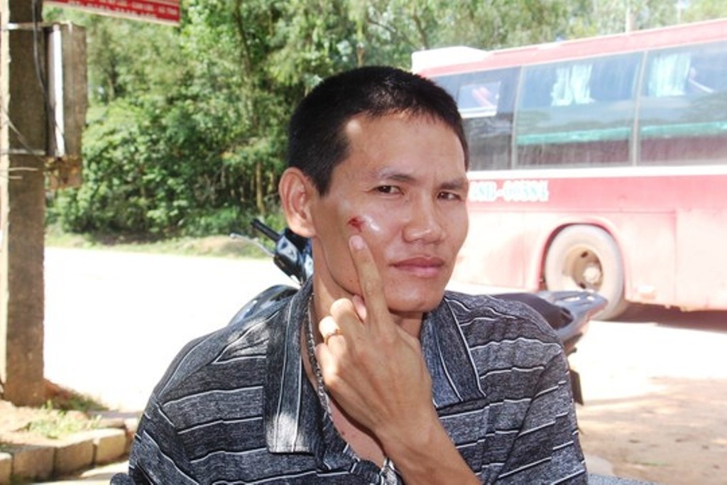 Anh Trần Văn Tuấn (chủ xe) bị nhóm côn đồ hành hung khiến chấn thương ở mặt.