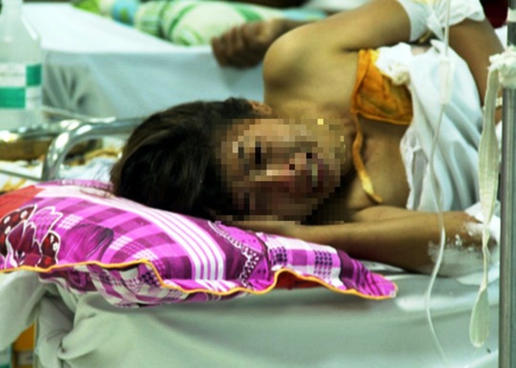 Chị Nhài đau đớn tại bệnh viện với vết bỏng 30%.