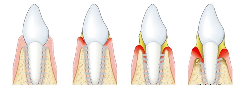 Sự tiến triển của vôi răng gây ra nha chu.