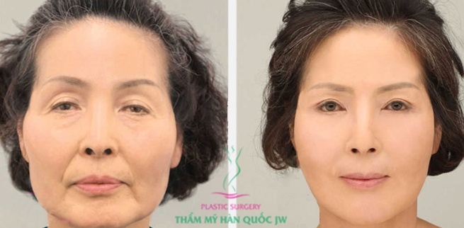 Hình ảnh trước và sau căng da mặt bằng chỉ.
