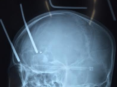 Thoat chet than ky khi bi cao sat bo trung dau sau 9 cm hinh anh