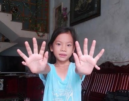 Co be co 24 ngon tay, chan o Quang Nam hinh anh