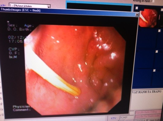 Cuu song benh nhan bi tam dam vao ruot hinh anh