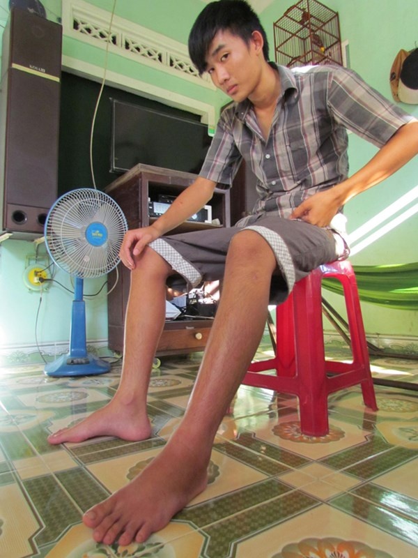 Chân trái của em Thật bị rắn lục đuôi đỏ cắn vẫn còn sưng. Ảnh: C.X