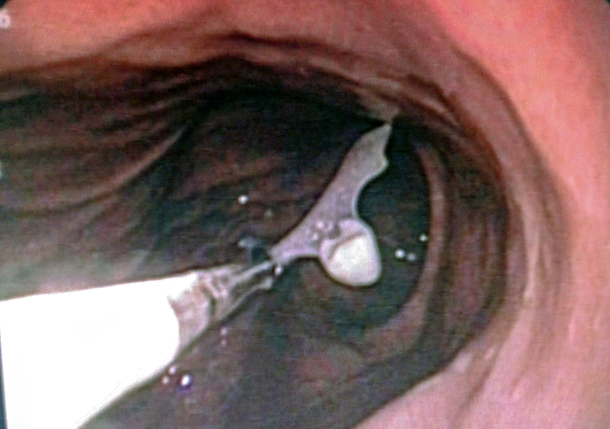 Nhap vien cap cuu vi nuot ham rang gia hinh anh