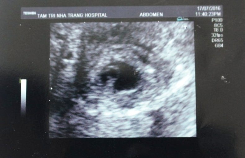 Cuu song san phu mang thai ngoai tu cung hinh anh