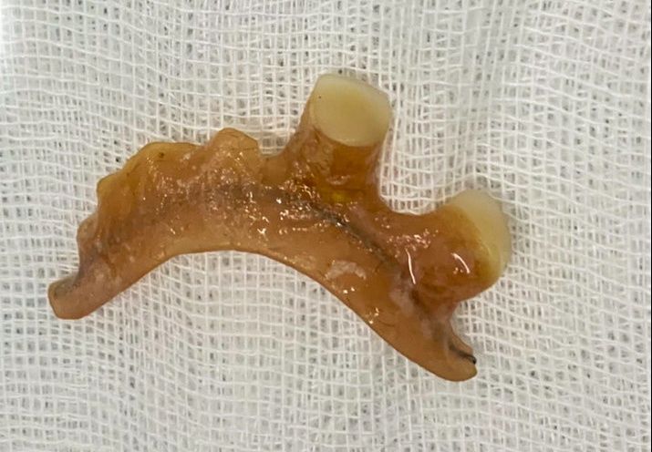 Nguoi phu nu nuot phai ham rang gia trong luc an hinh anh