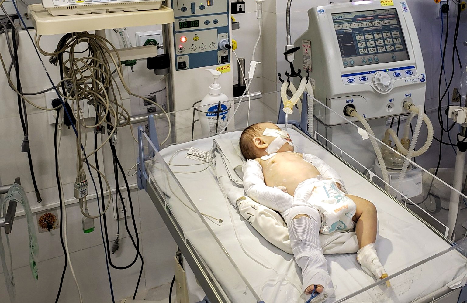 Chau be 3 thang tuoi bi bao hanh gay tay chan, chan thuong so nao hinh anh