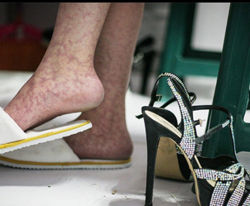 Giãn tĩnh mạch là bệnh nghề nghiệp của người mẫu. Đôi chân của họ phải chịu đựng rất nhiều nỗi đau bởi giày cao gót và những lần trình diễn trên sàn catwalk dài nhiều mét. Hình ảnh trên là cận cảnh của một đôi chân người mẫu bị phù nề và giãn tĩnh mạch.