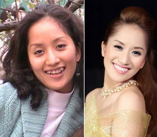 Khánh Thi từng sở hữu hàm răng đen và khấp khểnh.