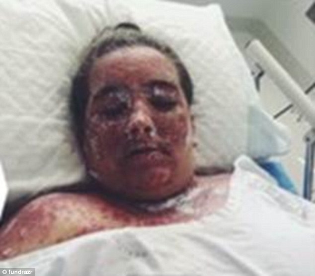 Co gai bi bong 98% do su dung thuoc tay trang da hinh anh