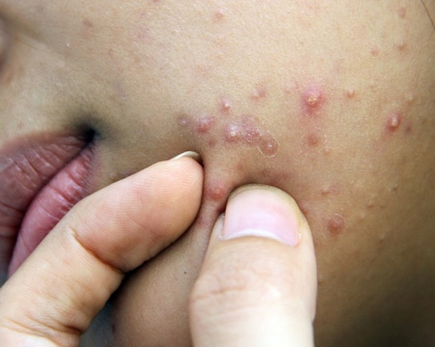 Moi nguy hiem khi nan mun trung ca con non hinh anh