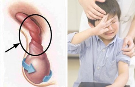 Hình minh họa xoắn tinh hoàn. Ảnh: TL.