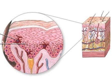 Gia tăng sắc tố melanin làm thâm da.