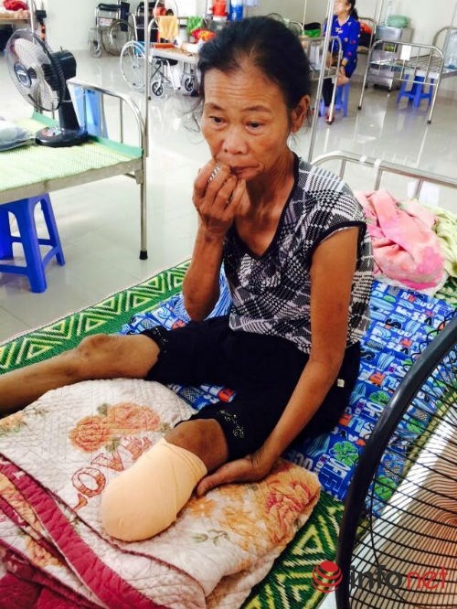 Bà Gái vừa bị cắt chân vì biến chứng tiểu đường.