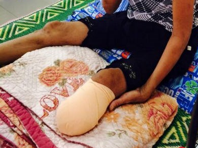 Mot tuan bi nhot, phai nhap vien cat chan hinh anh