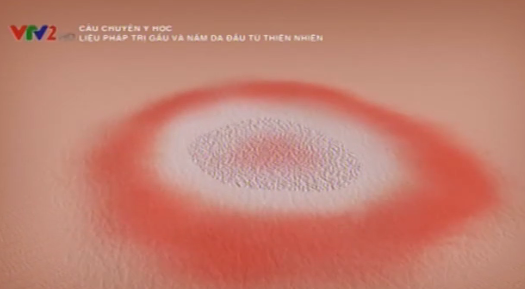 Bac si tu van cach chua tri gau, nam bang thao duoc hinh anh