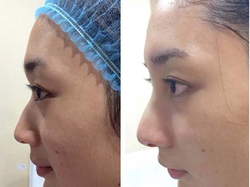 A hau Thai Lan ngang nhien khoe anh sua mui hinh anh