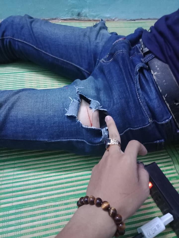 Nam sinh bị cướp dùng dao lam rạch chân ảnh 1 Nam sinh bi cuop dung dao lam rach chan anh 1